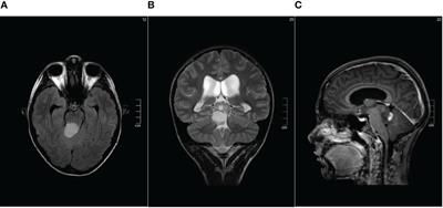 Bevacizumab-Irinotecan combination therapy in recurrent low-grade glioma, previously treated with chemo-radiotherapy: a case report